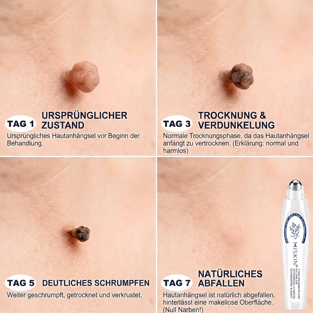 𝐇𝐈𝐒𝐊𝐈𝐍®👩‍⚕️ 7-Tage Skin Tag & Spot Eraser – Sanfte, präzise Pflege für sichtbare Hautunregelmäßigkeiten mit Roll-on-Applikator