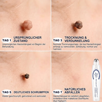 𝐇𝐈𝐒𝐊𝐈𝐍®👩‍⚕️ 7-Tage Skin Tag & Spot Eraser – Sanfte, präzise Pflege für sichtbare Hautunregelmäßigkeiten mit Roll-on-Applikator