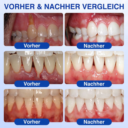 𝐇𝐈𝐒𝐊𝐈𝐍® 👩‍⚕️🇩🇪🏅🦷🛡️ GumRevive Parodontal-Reparaturgel