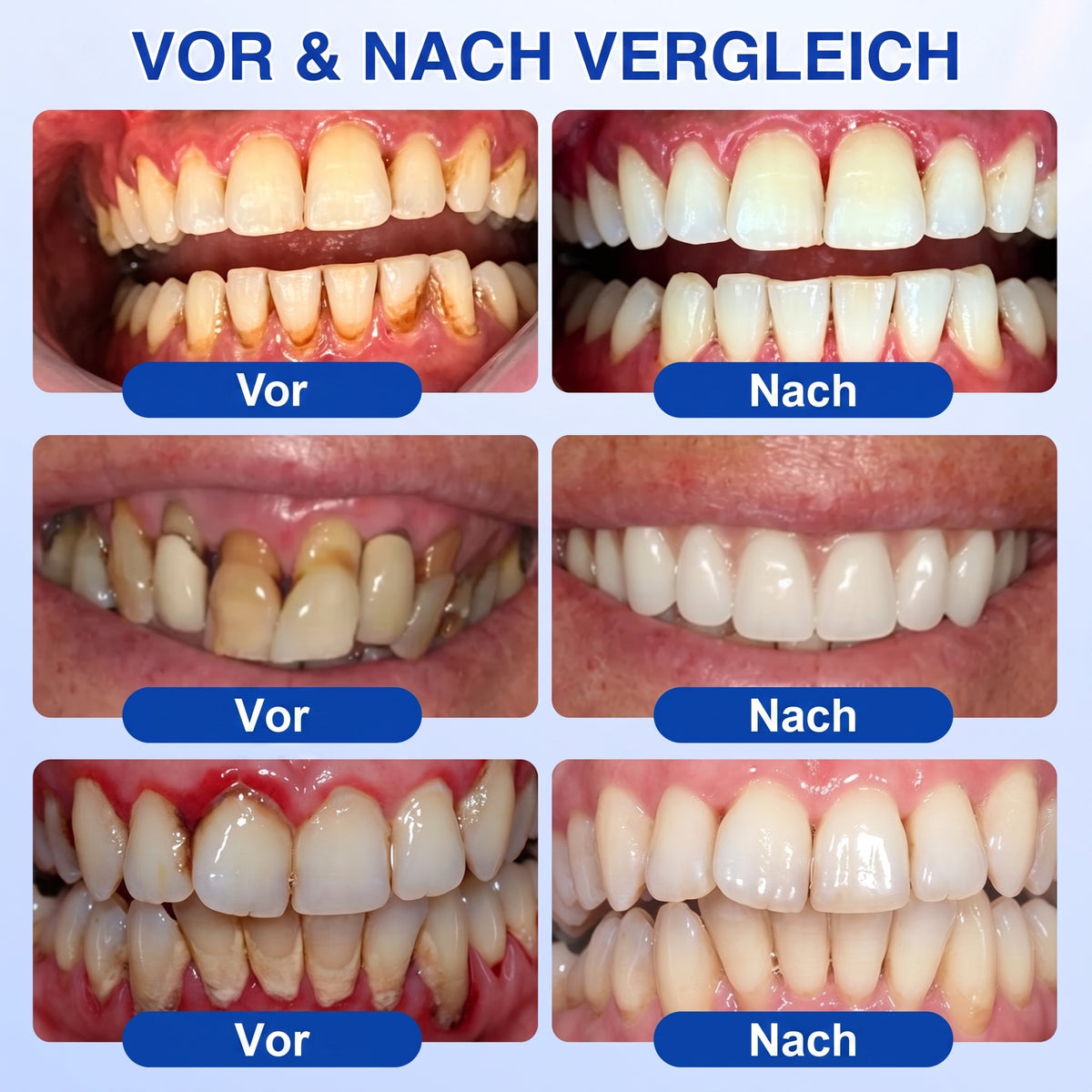 𝐇𝐈𝐒𝐊𝐈𝐍® 👩‍⚕️🇩🇪🏅🦷🛡️ GumRevive Parodontal-Reparaturgel