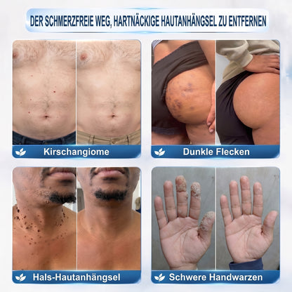 𝐇𝐈𝐒𝐊𝐈𝐍®👩‍⚕️ 7-Tage Skin Tag & Spot Eraser – Sanfte, präzise Pflege für sichtbare Hautunregelmäßigkeiten mit Roll-on-Applikator