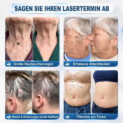 𝐇𝐈𝐒𝐊𝐈𝐍®👩‍⚕️ 7-Tage Skin Tag & Spot Eraser – Sanfte, präzise Pflege für sichtbare Hautunregelmäßigkeiten mit Roll-on-Applikator