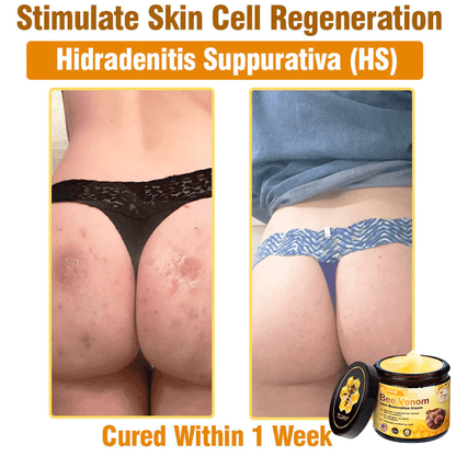 Hergestellt & versendet aus Deutschland 🇩🇪 Solaroza® Bienengift-Regenerationscreme. Starkes Anti-Aging. 100% Bienenfreundlich. ⏰ NUR NOCH HEUTE: 80% RABATT 💖