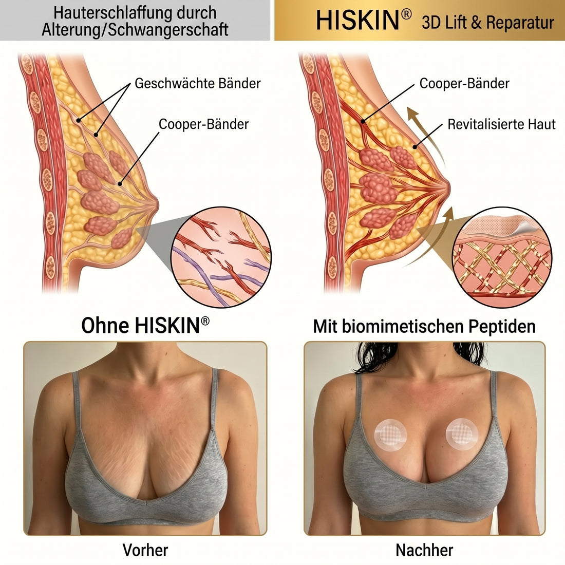👩‍⚕️Brust-Straffung & Fülle HISKIN® & Fortgeschrittenes Nano-Mikronadel-Pflaster für gezielte